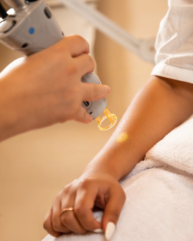 Tattoo Removal